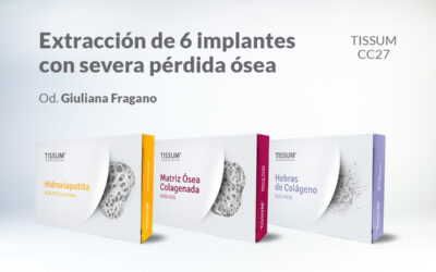 Extracción de 6 implantes con severa pérdida ósea