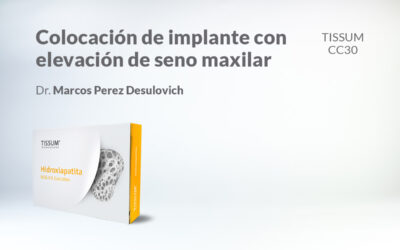 Colocación de Implante con Elevación de Seno Maxilar