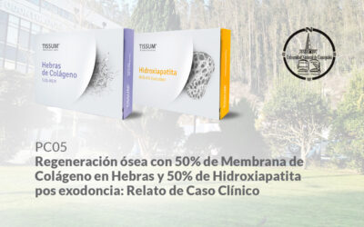 ROG con 50% Hebras de Colágeno y 50% Hidroxiapatita pos-exodoncia